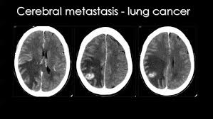 Pin By Andres Sanchez On Neuroanatomy Mri Brain Brain Tumor Neuropsychology