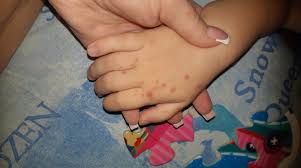 In majoritatea cazurilor, infectia va disparea fara tratament in 7 pana la 10 zile. GurÄ ManÄ Picior 2 Republikanews