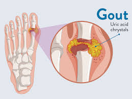 12mm+ questions answered · helped over 8mm worldwide About Gout Managing And Preventing Attacks Boulder Medical Center