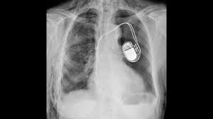 Cu privire la tehnologii de tip cookie. ViaÈa Cu Stimulator Cardiac Pacemaker RÄspunsuri La Cele Mai Frecvente IntrebÄri Youtube