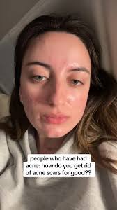 Scar My People Ft Pongo Ristaz