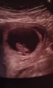 Eight weeks into a pregnancy is the most common time to have a first ultrasound, also called the dating scan, as one of the main purposes is to determine gestational age. 7 Weeks Pregnant Dating Scan