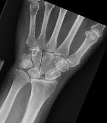 Image result for Fall on Outstretched Hand