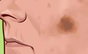Yuzdeki Kahverengi Lekelerin Kesin Tedavisi Icin Bitkisel Dogal Maske Bitkisel Dogal Icin Kahverengi Kesin Lekel Yuzler Dogal Evde Hazirlabilen Ilaclar