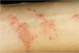 Image result for Rhus Dermatitis