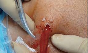 Maybe you would like to learn more about one of these? Drainage From An Infected Arthroscopy Portal Immediately Before The Download Scientific Diagram