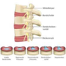 Bandscheibenvorfall Symptome Und Richtigen Arzt Finden