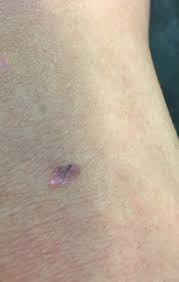 Find facts and statistics for reporting about skin cancer. Caroline Jones A Twitter Melanoma This Tiny Little Mark Above My Right Knee Was Malignant Melanoma But I Had It Checked As Soon As I Noticed It So Caught It At