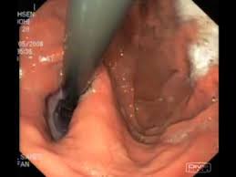 When does a hiatal hernia need surgery. Endoscopy In Hiatal Hernia Youtube