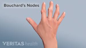 Maybe you would like to learn more about one of these? Recognizing Osteoarthritis In The Hand