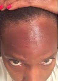 Maybe you would like to learn more about one of these? Dark Skin Does Sunburn My Trip To Cancun Dark Skin Skin Sunburn