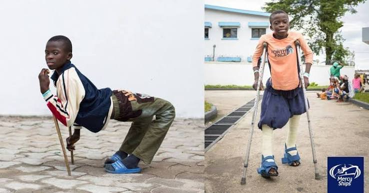 Mercy - Straight legs mean a new start in life for 12-year-old Ulrich, who has now received free surgery on the #AfricaMercy to correct his backward facing legs: “Before, people would just