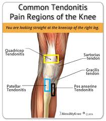 Knee Tendonitis Anatomy Common Areas Of The Knee That Are Afflicted With Tendonitis The Quadriceps And A Knee Arthritis Knee Tendonitis Knee Injury Treatment