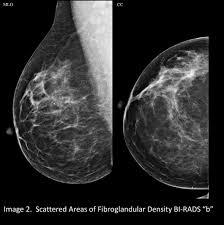 Any area that does not look like normal tissue is a possible cause for concern. Your Patient Got A Dense Breast Notification With Her Mammogram Report What Are You Supposed To Do Christianacare News