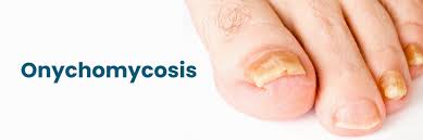 Image result for onychomycosis