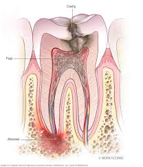Cavities and tooth decay are among the world's most common health problems. Tooth Abscess Symptoms And Causes Mayo Clinic