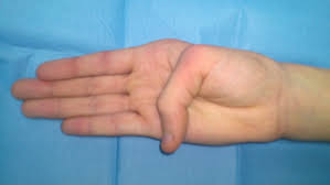 From old spanish pulgar, from latin pollicāris, from pollex. Continuum Nino De 13 Anos Con Signo De La Muneca Y El Pulgar Positivos