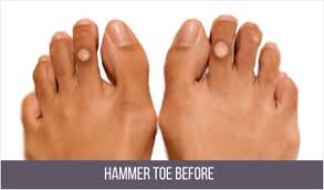 Claw toe causes the affected toe to dig down into the sole of the shoe, which can lead to painful calluses. Hammertoe Surgery Nyc Hammertoe Treatment Specialist Manhattan