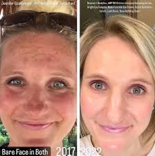 Melasma is a condition in which brown patches appear