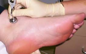 Image result for diabetic toes