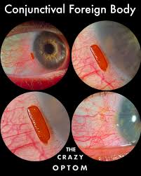 Image result for Conjunctival Foreign Body