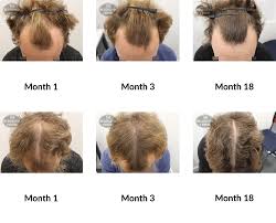 Can last around 3 months.) at any given time, the hairs on your head are in different parts of each phase. Hair Growth Success Story I Feel A Lot More Confident