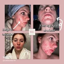 How I changed my skin