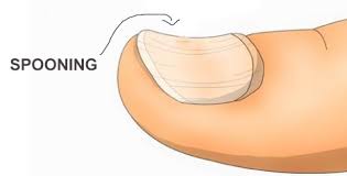 Image result for Koilonychia feet