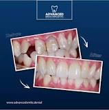 What are Zirconia Dental Implants and How Much do they cost ...