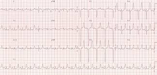 electrolyte abnormalities