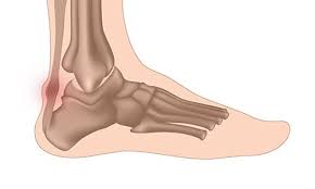 Le traitement orthopédique a consisté en une immobilisation plâtrée soit dans une botte plâtrée soit. Origine De La Tendinite Du Tendon D Achille Traitement Tendinite Tendinite Tendinite Tendon Achille