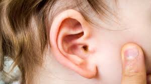 Five out of six children will have an ear infection before their 3rd birthday, according to the. Ear Wax In Children What To Do About It Raising Children Network