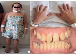 Toulouse lautrec zum kleinen preis bestellen. Scielo Brasil Update Of Dental And Maxillofacial Alterations In Patients With Pycnodysostosis Update Of Dental And Maxillofacial Alterations In Patients With Pycnodysostosis