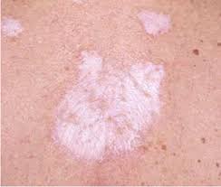 To make it more curvier and prominent. 13 Common Causes For Itchy Butt Rashes And Bumps According To Mds