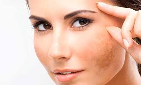 Melasma is a common skin problem. Que Es El Melasma Como Eliminarlo Perez De La Romana