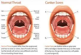 Treat fever blisters on the outside of the lips and mouth now. Best Canker Sore Treatment In India Mouth Sore Cure Near Me