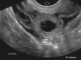 Image result for corpus luteum sonography)