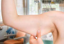 This actually strangles the flesh, causing it to dry up and fall off. Thinking About Arm Lift Surgery Facts You Should Know Health Essentials From Cleveland Clinic