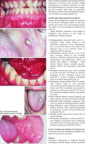 Image result for papillomavirus tongue)