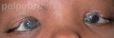 Image result for Coloboma