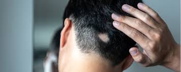 The respiratory virus is currently spreading in a growin Alopecia E Caduta Capelli Cause E Cura