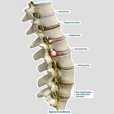 spine conditions labeled chart