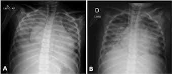 Check spelling or type a new query. Miocardites Em Pediatria