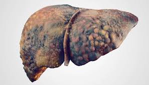 Cirrhosis is not reversible, though it can be managed or the progression slowed through treatment and complete abstinence from alcohol. Alcoholic Liver Disease Symptoms Treatment And Causes