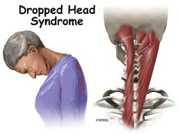 The neck lies between the head and the greater and lesser tubercles. Dropped Head Syndrome Eorthopod Com