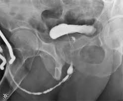 Image result for Retrograde Urethrogram