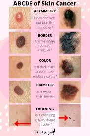 As a rule, the lower the number, the less the cancer has spread. Abcde S Of Skin Cancer What You Need To Know Tararrized