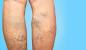 Varicose Veins