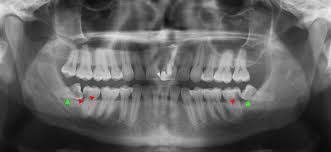 The treatment for wisdom tooth symptoms depends on the cause. 6 Ways To Deal With Wisdom Teeth Pain Pain Free Dental