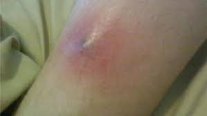A brown recluse bite can range from mild symptoms such as swelling and itching to more severe symptoms, including muscle pain, fever, and convulsions. Another Brown Recluse Bite Reported What You Need To Know Weyi